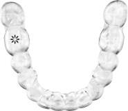 Aligners